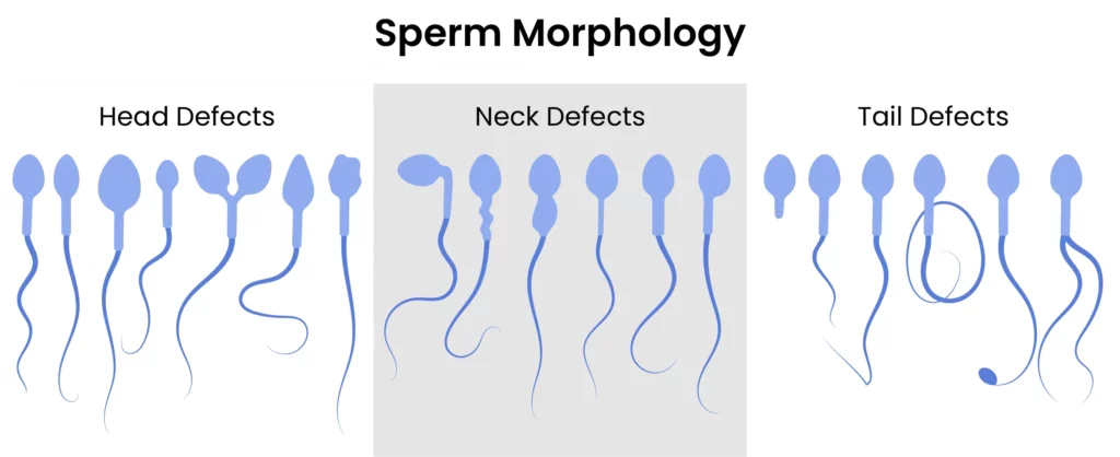 IVF and Male Infertility Causes Diagnosis and Treatment